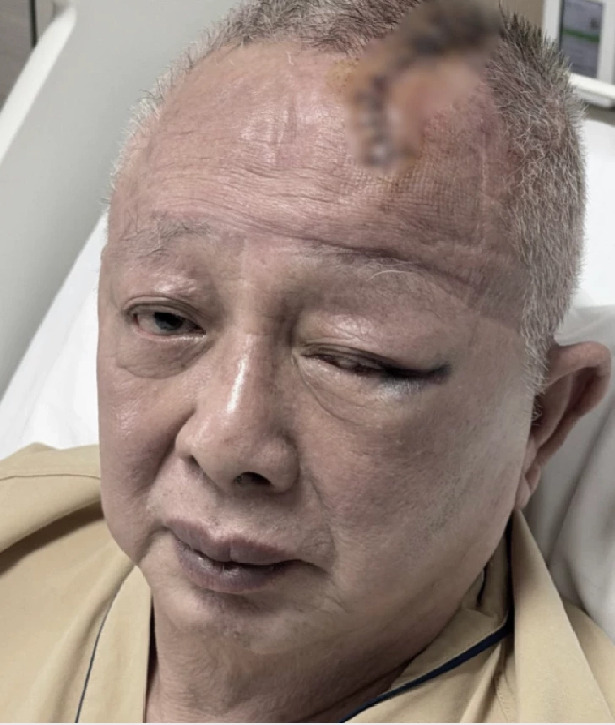 อัปเดตอาการ "สนธิ" ล้มหัวฟาดเสาเย็บ 20 เข็ม เผยลางสังหรณ์เหมือนมีคนผลัก