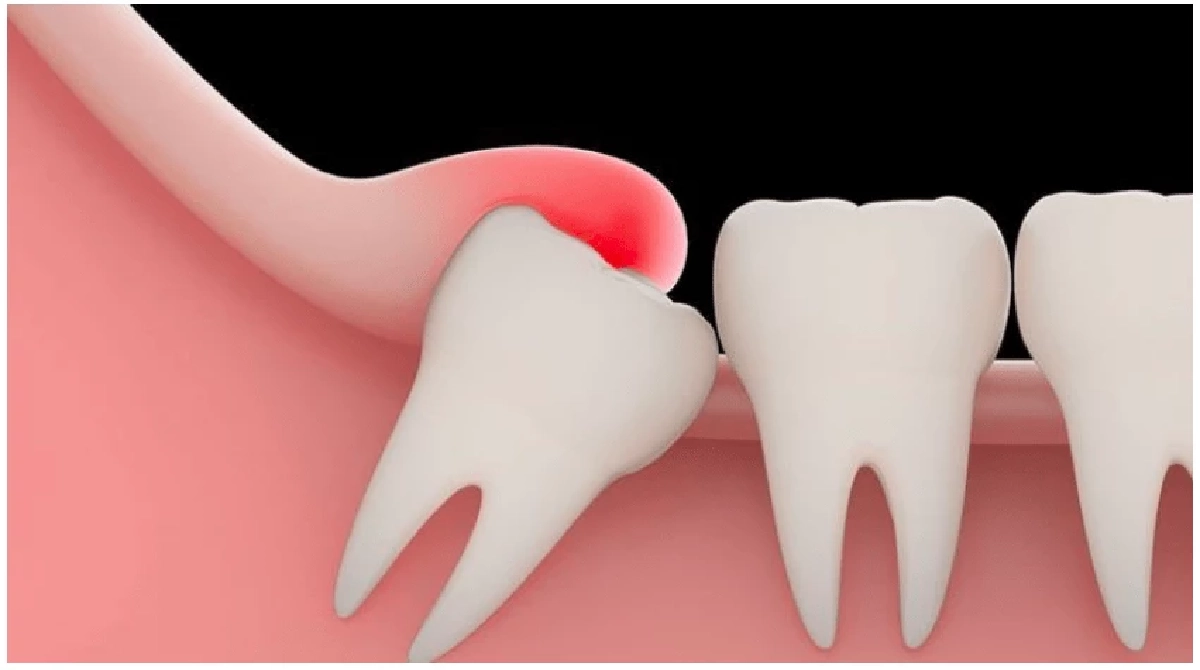 ประกันสังคมเคาะ “ผ่าฟันคุด” ไม่ต้องสำรองจ่าย 1 พ.ค. นี้ แต่อาจหาที่ทำยาก