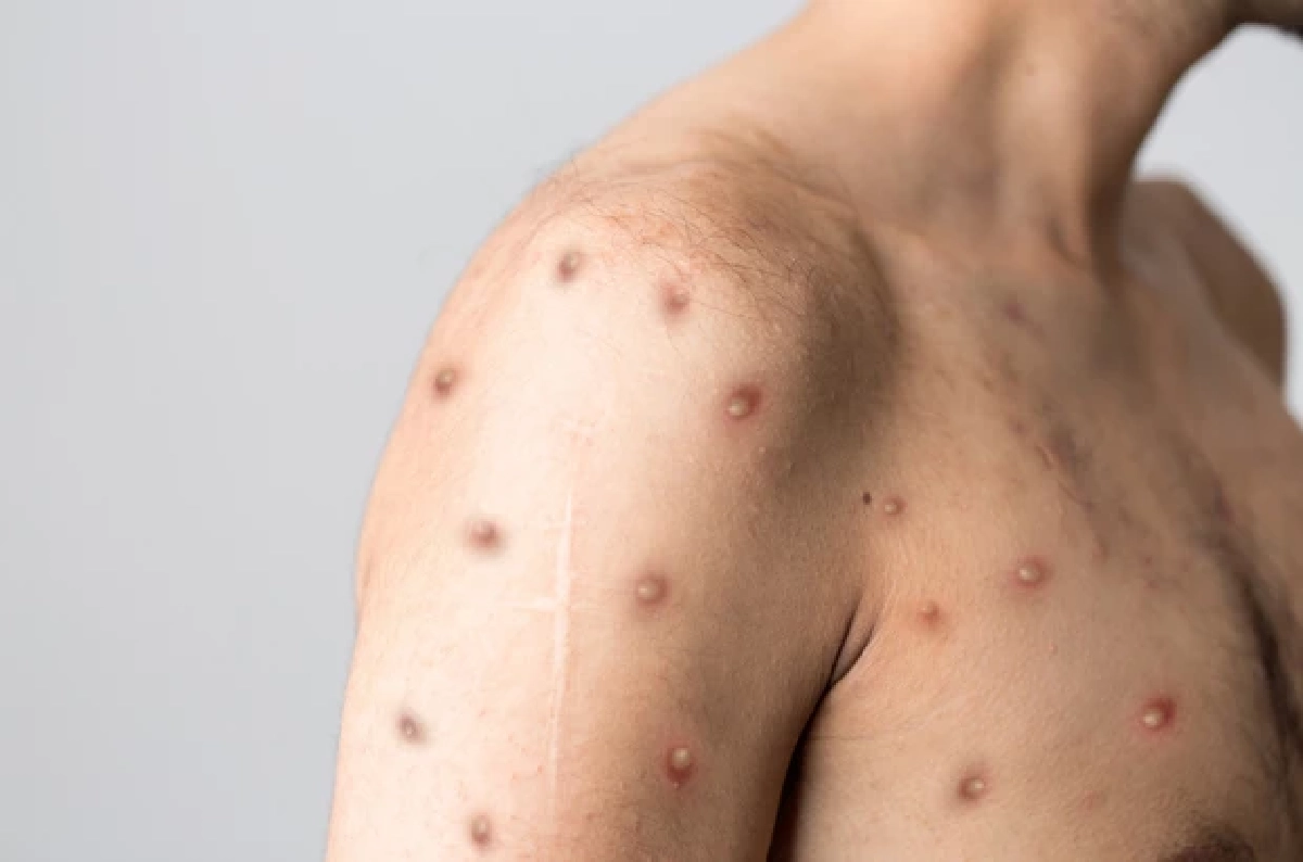 เปิดสถิติฝีดาษวานรปี 69 พบผู้ป่วยใหม่ในไทย 9 รายในเดือนเดียว