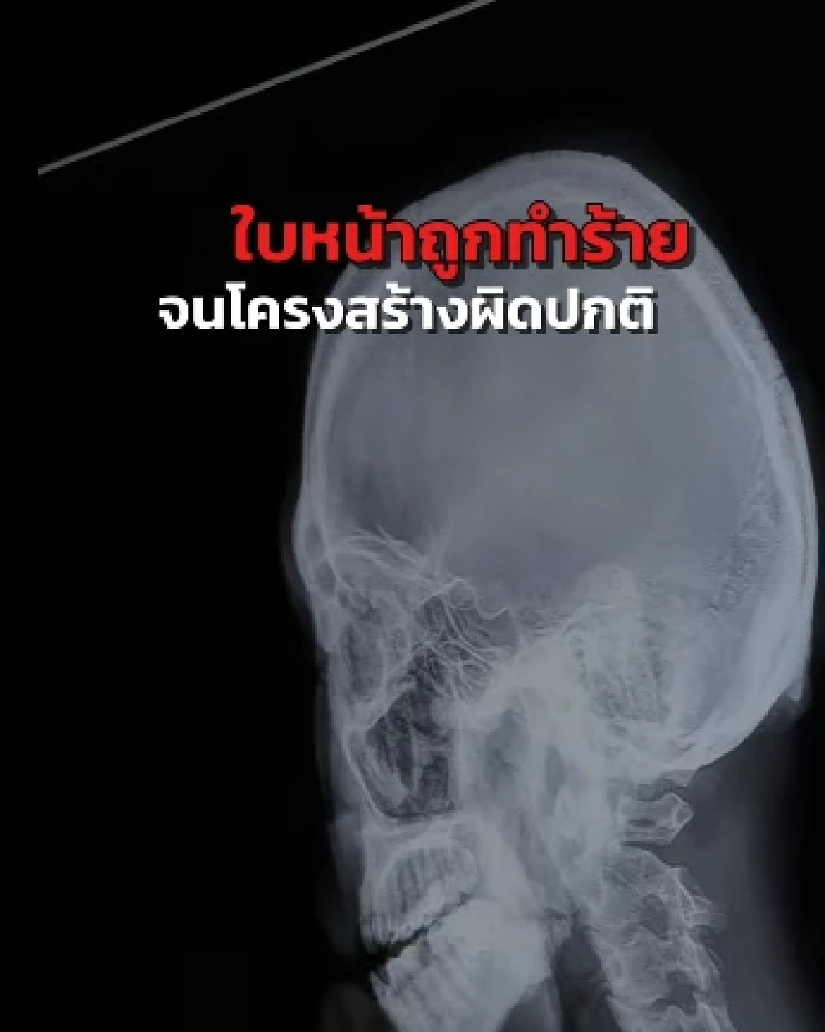 จำแทบไม่ได้ "น้องฟ้า" เหยื่อนายจ้างทารุณ จนใบหน้าผิดรูป ล่าสุดเหมือนเกิดใหม่