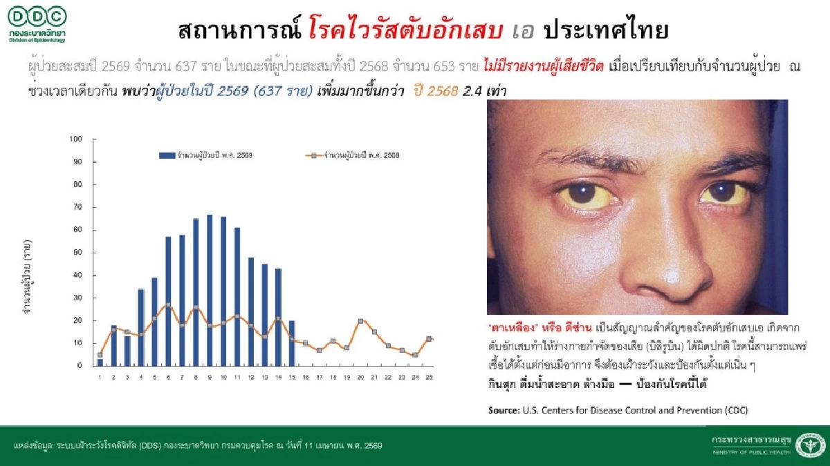 หน้าร้อนต้องระวัง “ตับอักเสบเอ” อาละวาด สถิติพุ่งสูงกว่าปีก่อนเท่าตัว