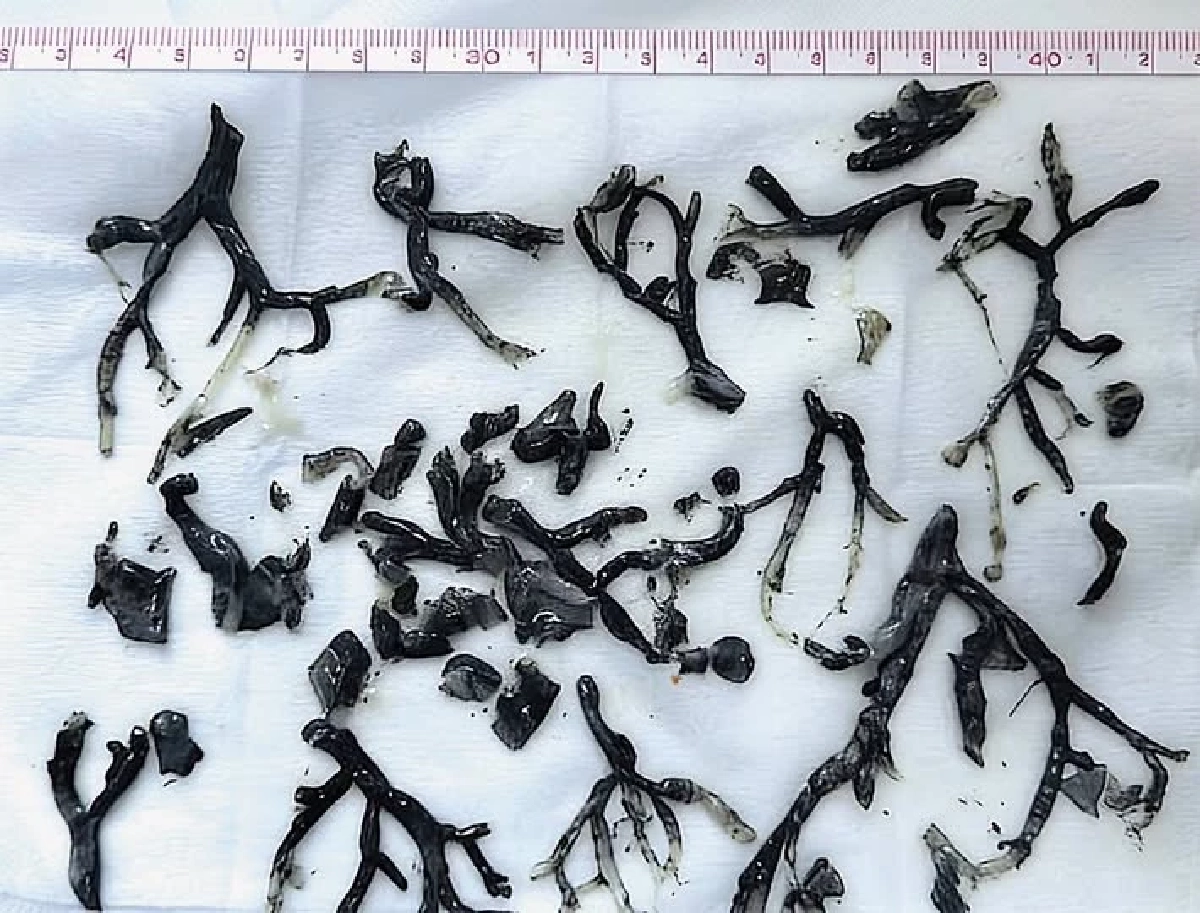 พื้นที่เผาป่า อันตราย! "เขม่าควันไฟ-ฝุ่น" อัดเป็นก้านสีดำ เสี่ยงหายใจล้มเหลว