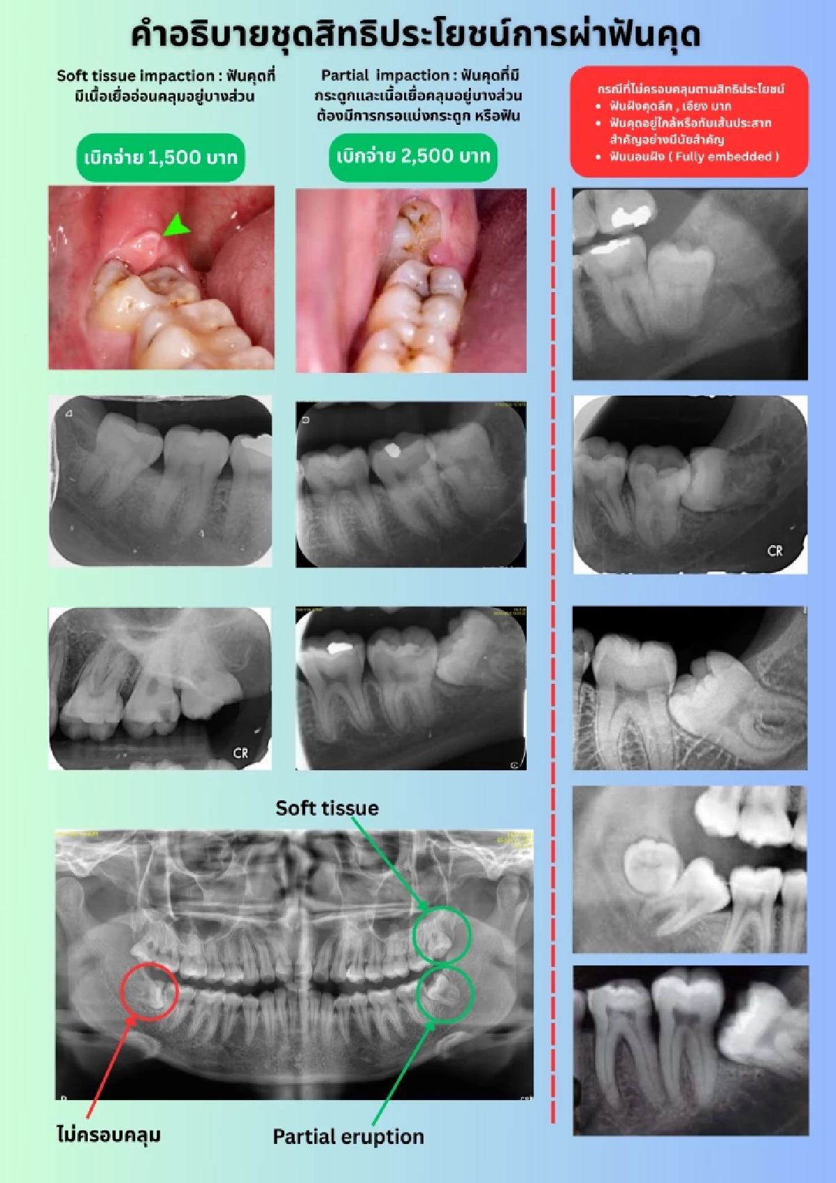 ทันตแพทยสภา อธิบายสิทธิประโยชน์ "ผ่าฟันคุด" ในคลินิก สำหรับผู้ประกันตน