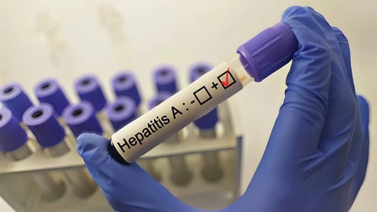 เช็ก 4 จังหวัด "ไวรัสตับอักเสบเอ" ระบาดพบผู้ป่วย 672 ราย