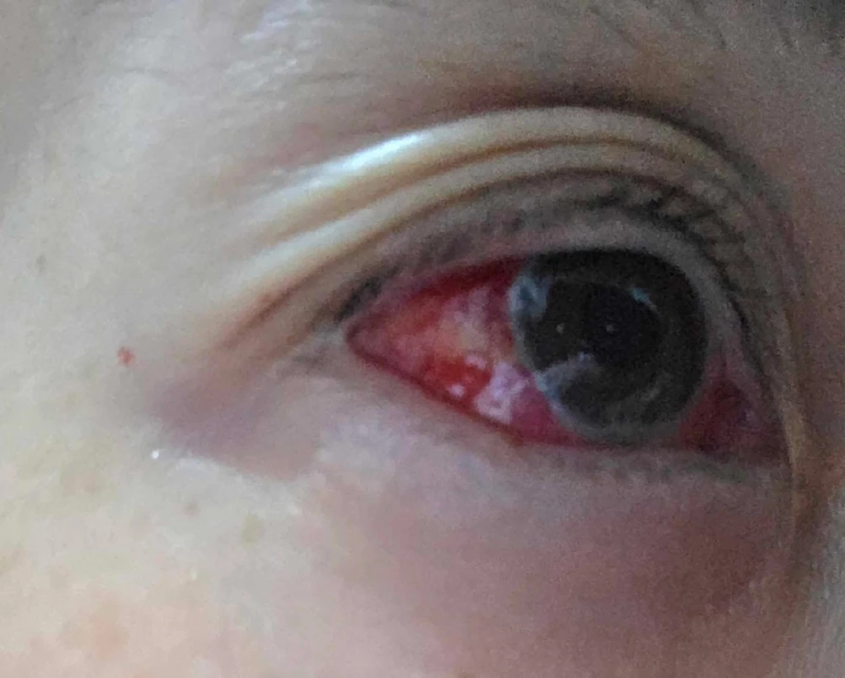 ค่าฝุ่น PM เชียงใหม่ ทำพิษ! คนxายผ่อนส่งมากขึ้น โดยเฉพาะเด็กๆ