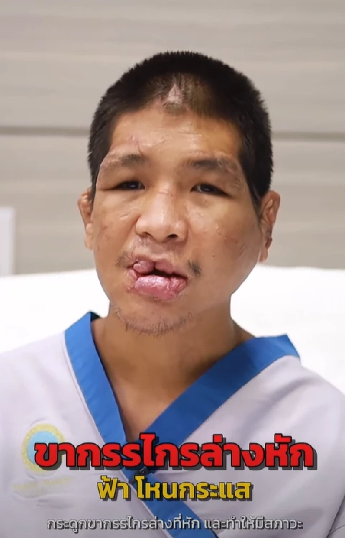 จำแทบไม่ได้ "น้องฟ้า" เหยื่อนายจ้างทารุณ จนใบหน้าผิดรูป ล่าสุดเหมือนเกิดใหม่