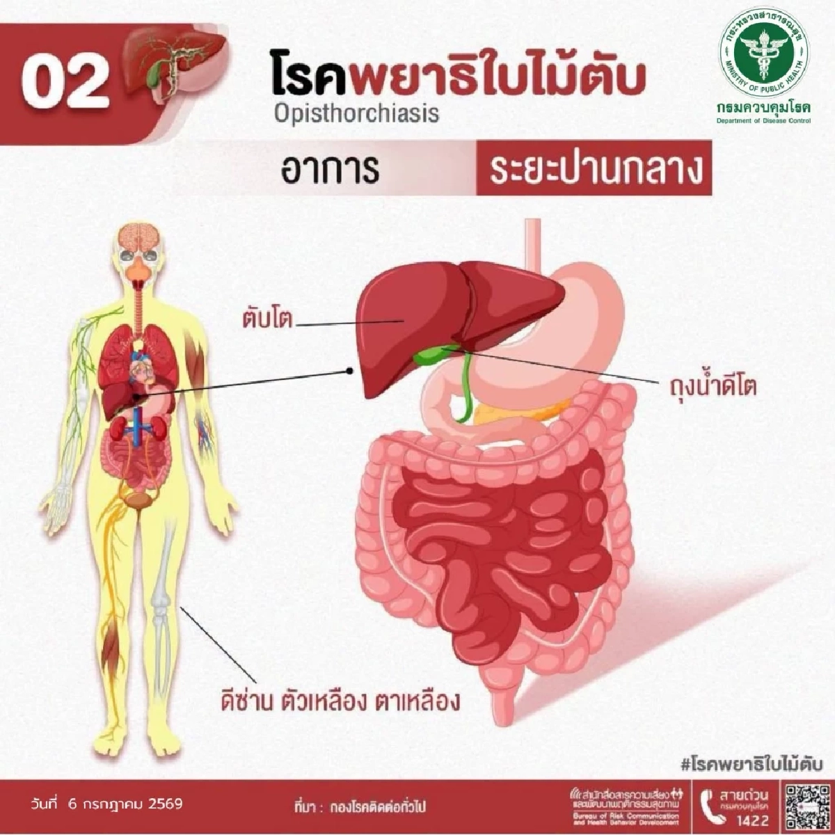 รู้จักโรค ‘พยาธิใบไม้ตับ’ ตัวการร้ายมะเร็งท่อน้ำดี เช็ก!อาการแบบไหนเสี่ยงลามถึงดับ