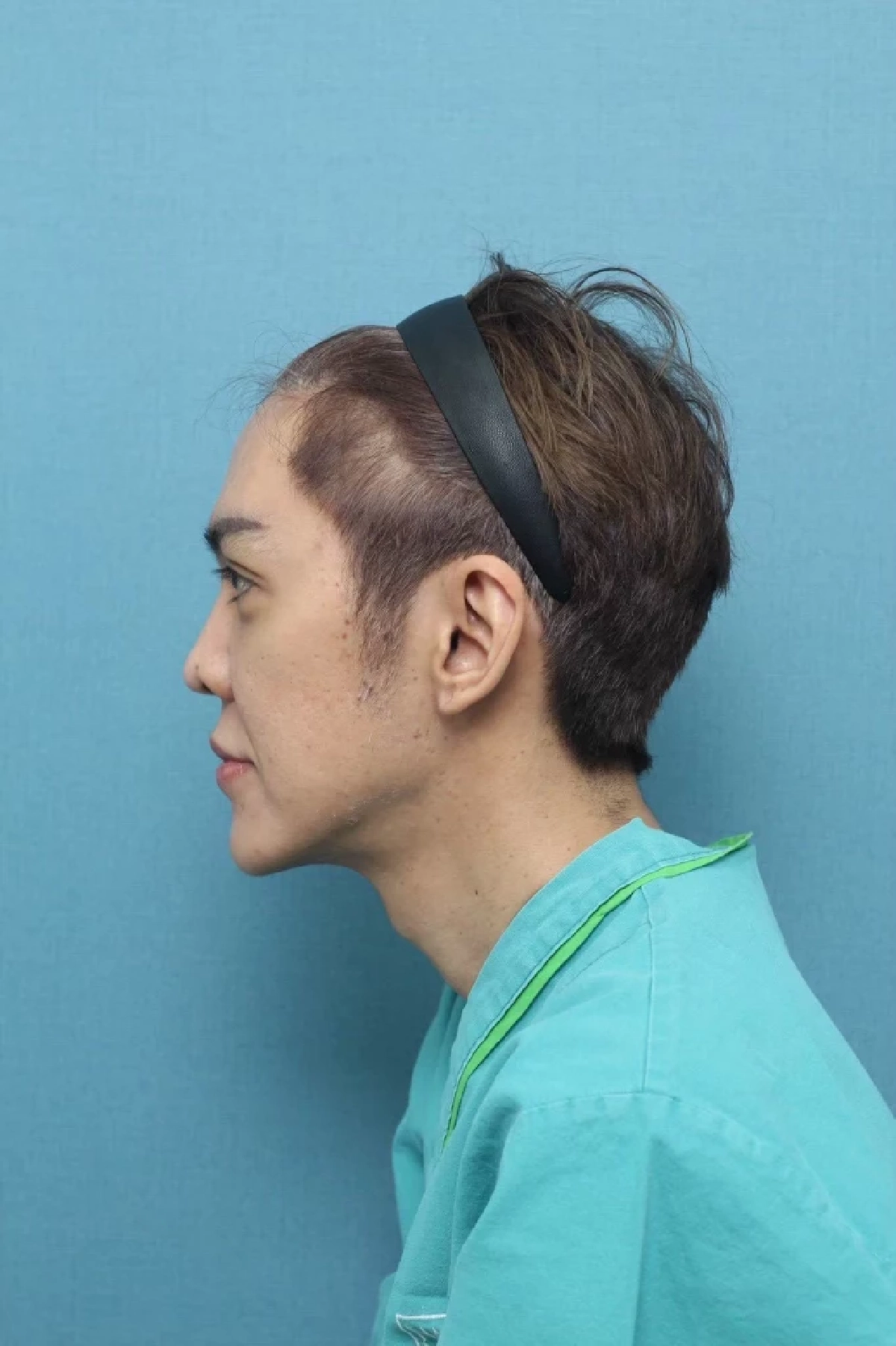 "ดัง พันกร" เผยหน้าเวอร์ชั่นล่าสุด เปิดใจหลังทำศัลยกรรมชุดใหญ่