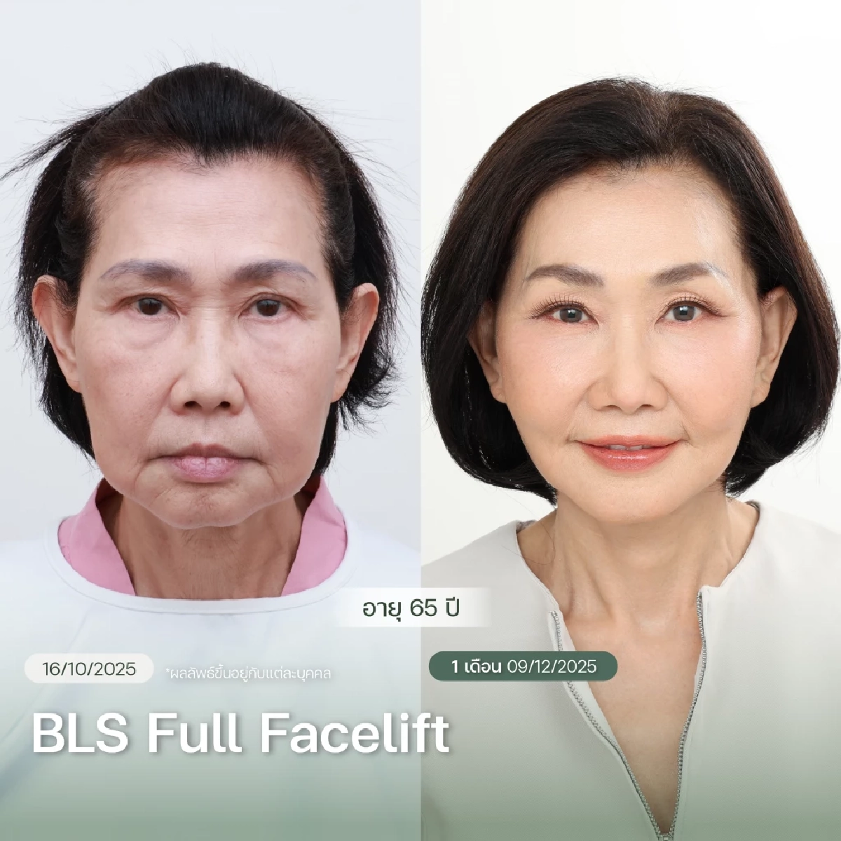 ถอดรหัสความสำเร็จ BLS Surgery Center คว้ารางวัล 2 ปีซ้อน