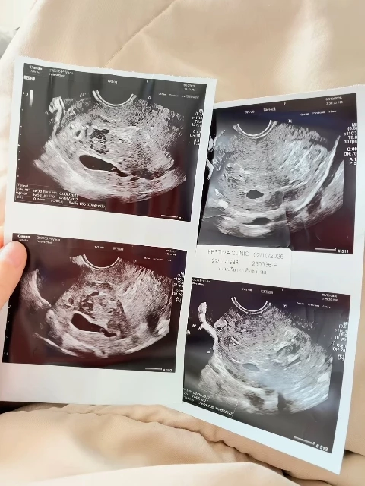 ส่งกำลังใจ "แก้มบุ๋ม" สูญเสียลูกในครรภ์ หลังพยายามมีลูกมาตลอด