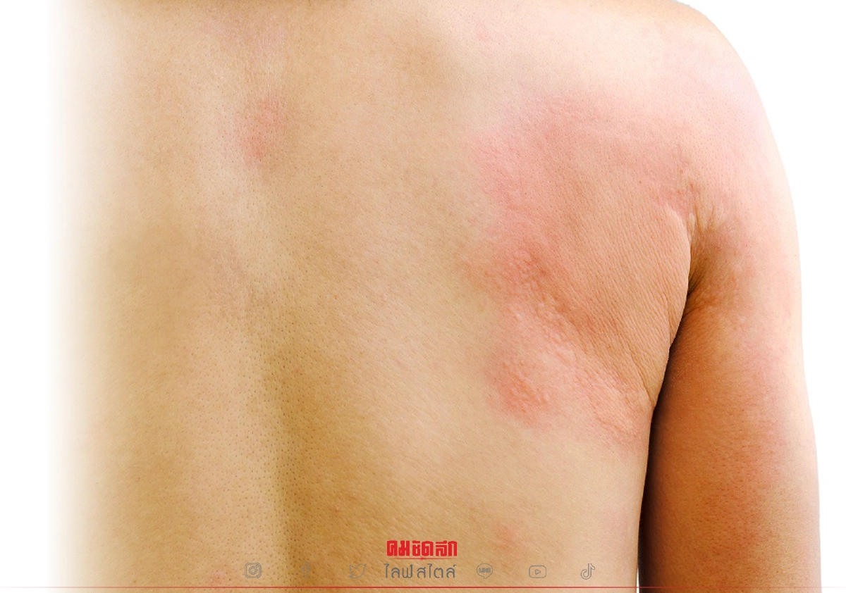 "โรคลมพิษ" อันตรายอย่างไร เมื่อใดควรไปพบแพทย์