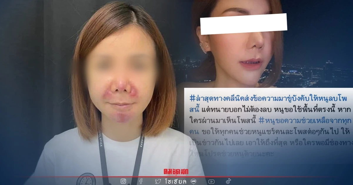 สาวแชร์อุทาหรณ์ฉีด "ฟิลเลอร์ปลอม" ทำหน้าพัง คลินิกขู่ลบโพสต์ทิ้ง สาวแชร์อุทาหรณ์ฉีด "ฟิลเลอร์ปลอม" ทำหน้าพัง คลินิกขู่ลบโพสต์ทิ้ง