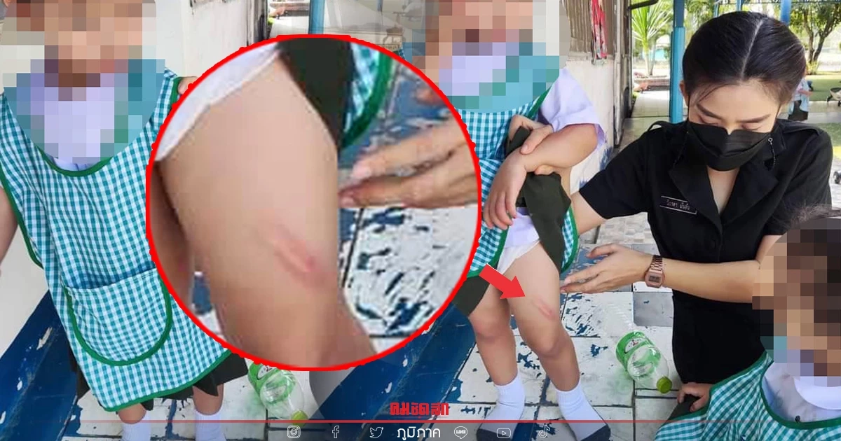 แม่สุดทน แจ้งจับ "พี่เลี้ยง"  ตีลูกสาววัย 2 ขวบ เป็นรอยแผลเขียวช้ำทั่วตัว