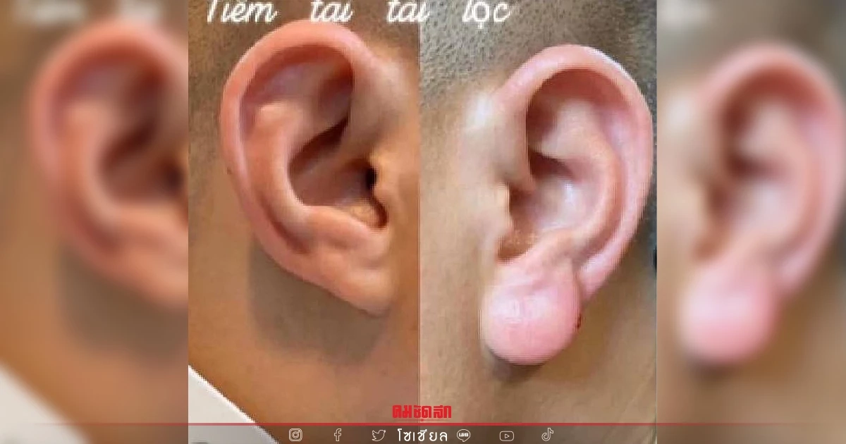 "ฟีลเลอร์" ฉีดติ่งหู "สายมู" ชาวเวียดนาม ฮิตทำเสริมดวง ร่ำรวย