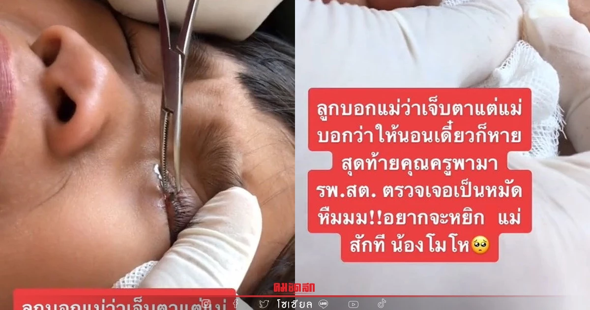 พ่อแม่รังแกฉัน ลูกเจ็บตา แม่บอกนอนเดี๋ยวก็หาย สุดท้ายพบ "หมัดเกาะตา" พ่อแม่รังแกฉัน ลูกเจ็บตา แม่บอกนอนเดี๋ยวก็หาย สุดท้ายพบ "หมัดเกาะตา"