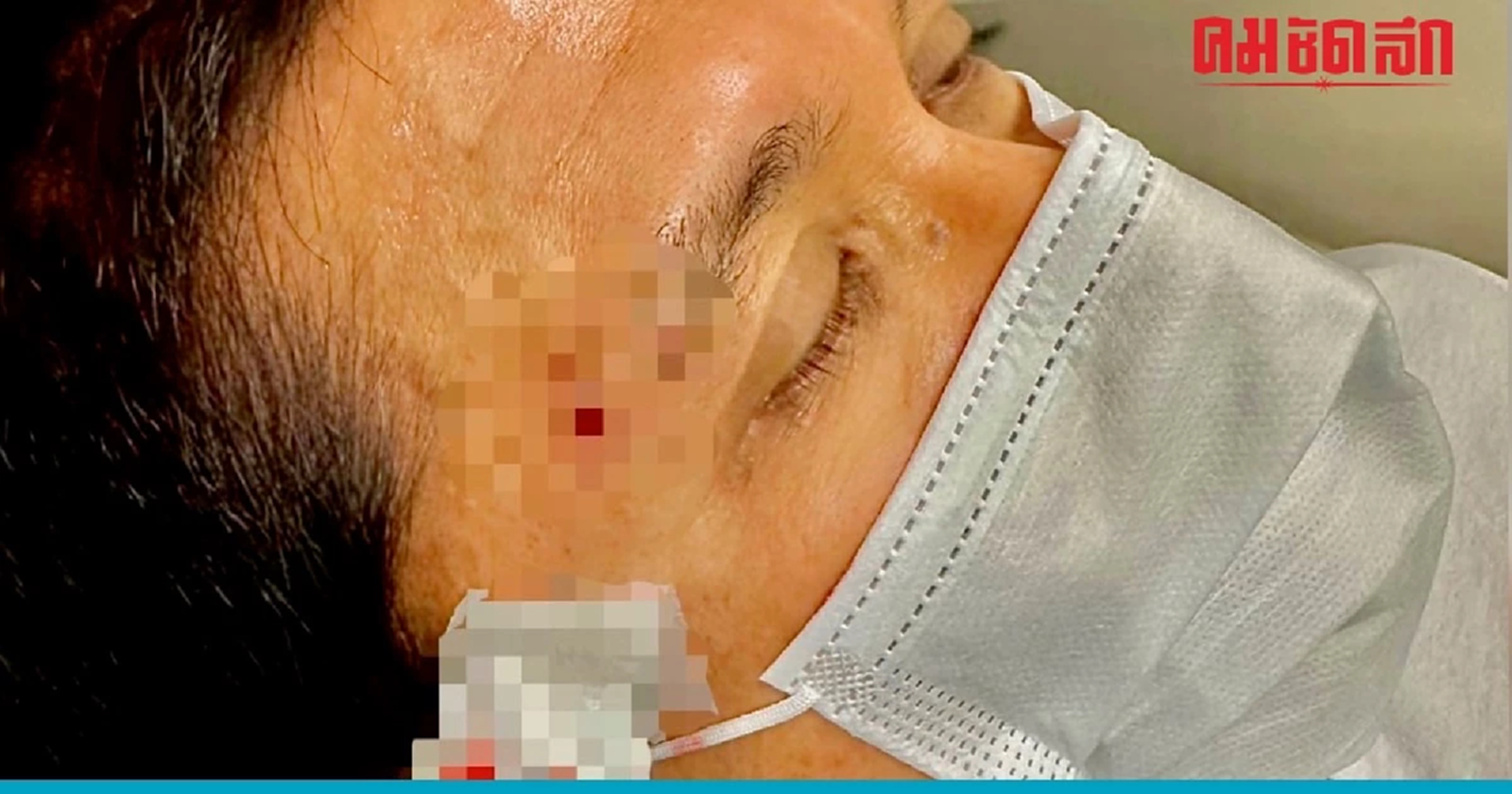 'ชนินทร์' หาเสียงหนักจน 'ติดโควิด-คิ้วแตก' ขอ 6 วัน ลุยเลือกตั้งโค้งสุดท้าย