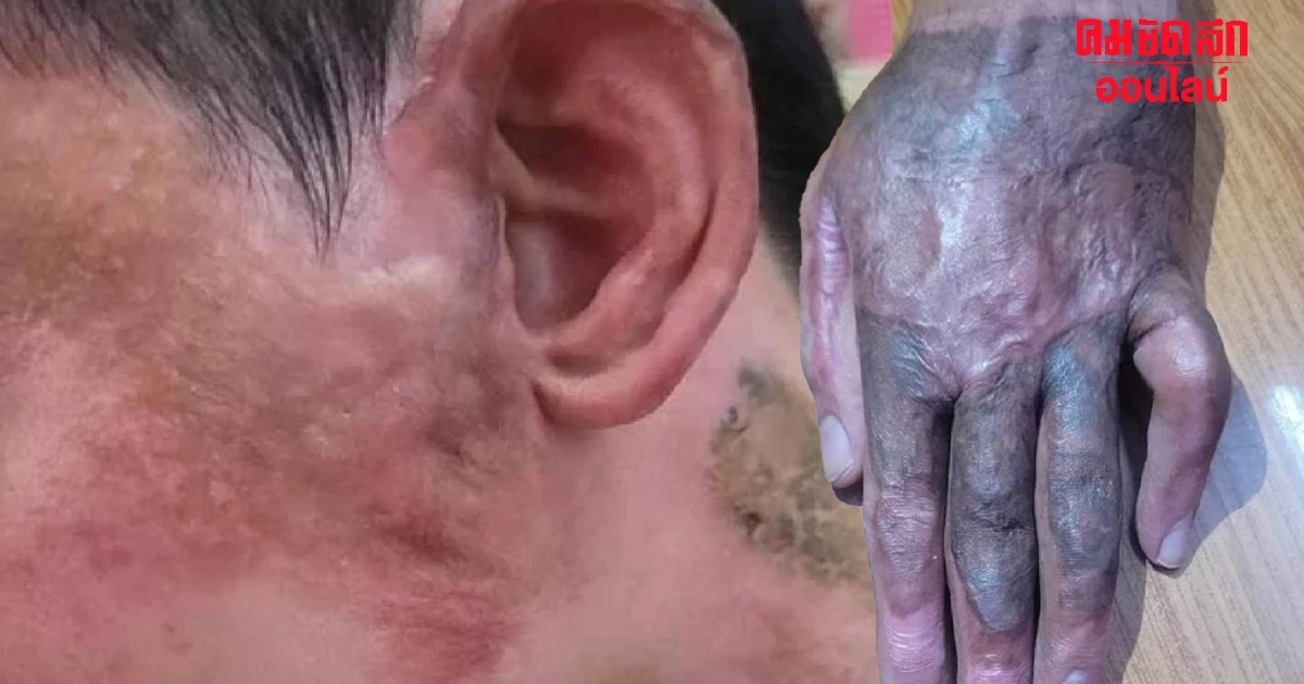 กฟน.ยันจ่ายสินไหมทดแทน หนุ่มโดนหม้อแปลงระเบิด อยู่ระหว่างรอเอกสาร