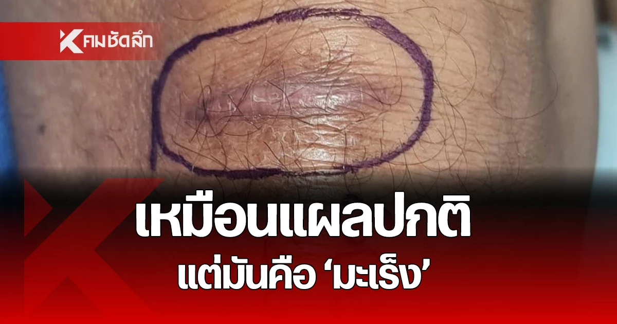 From Blister to Analysis: A Lady’s Journey Uncovers Pores and skin Most cancers at Walailak College Medical Middle