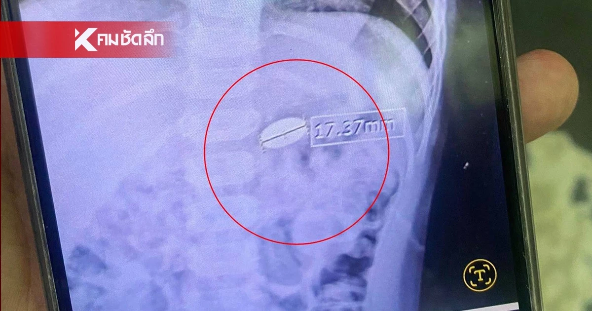 แม่โพสต์ บทเรียนชีวิต ลูกชาย กลืนเหรียญลงท้อง ยังรอขับถ่ายออกมา แม่โพสต์ บทเรียนชีวิต ลูกชาย กลืนเหรียญลงท้อง ยังรอขับถ่ายออกมา