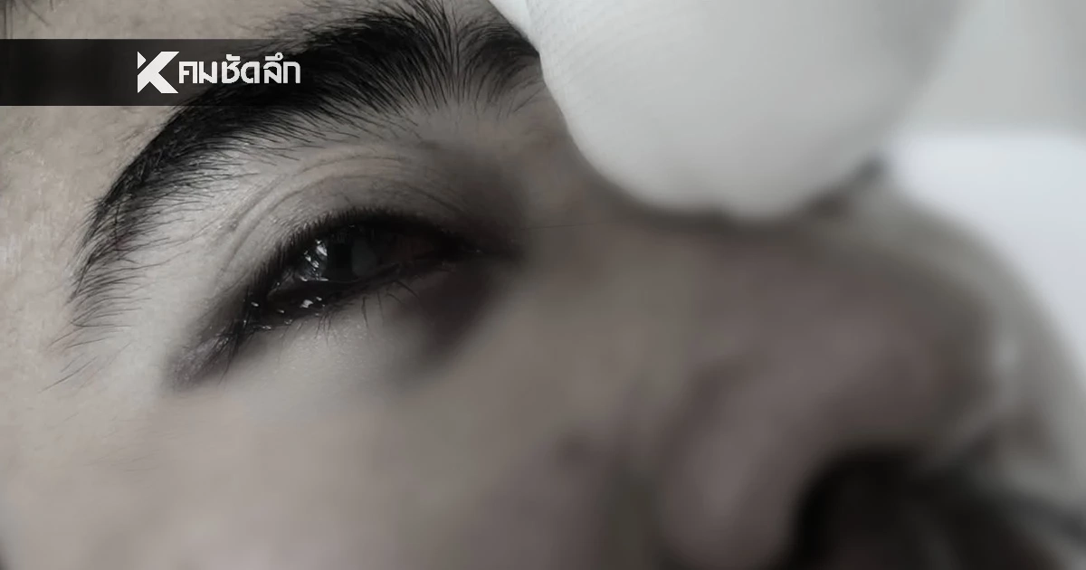 หนุ่มผ่าริดสีดวงจมูก พอฟื้นกลับมองไม่เห็น หมอพลาดตัดเส้นประสาทตา ไม่แจ้งญาติ