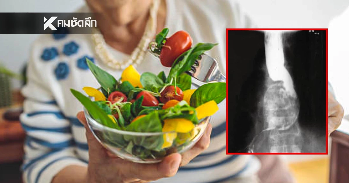 เตือนภัยคนชอบกินผักสด สยอง! พยาธิไส้เดือนตัวใหญ่ดิ้นคาหลอดอาหารยายวัย 70 ปี