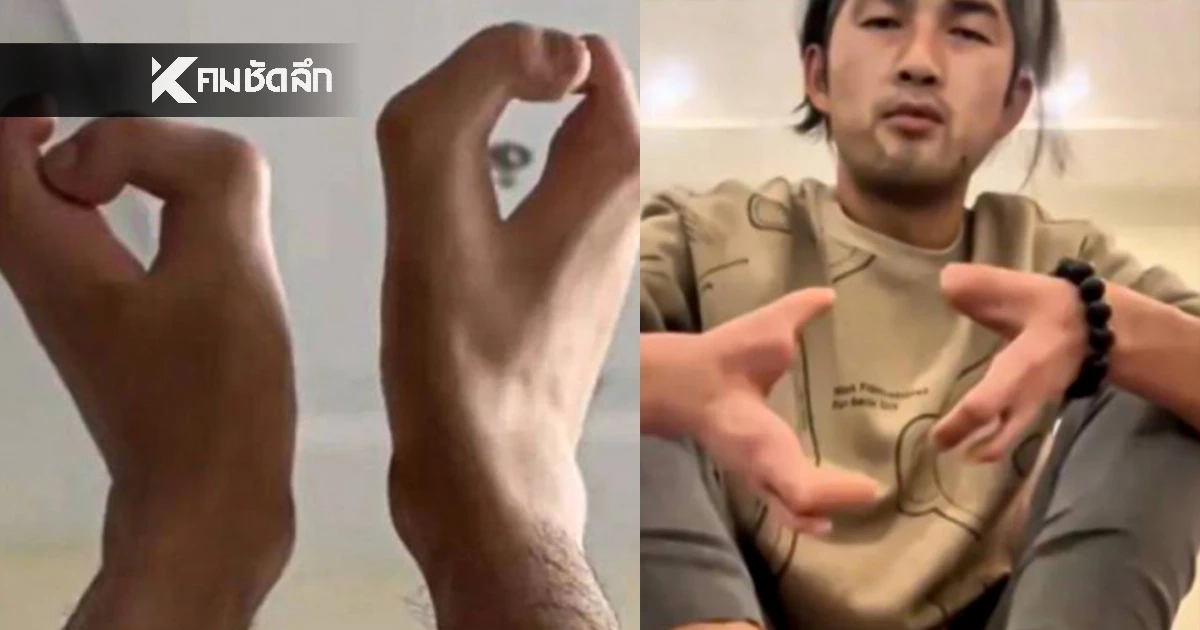 หนุ่มจีนมีมือเป็น "กล้ามปู" เท้าเป็น "กีบวัว" ต้นตอมาจาก "บาปบรรพบุรุษ"