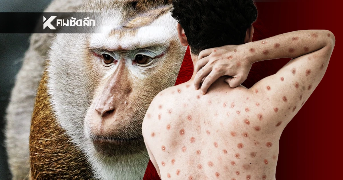 เปิดสถิติฝีดาษวานรปี 69 พบผู้ป่วยใหม่ในไทย 9 รายในเดือนเดียว