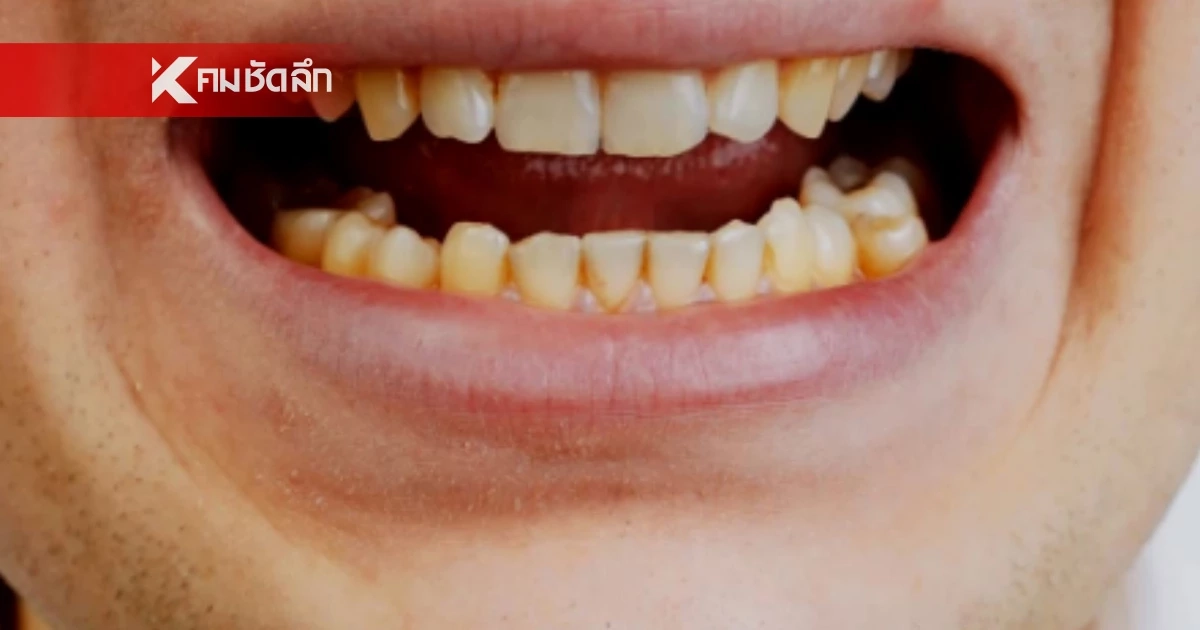 อย่าปล่อยให้ "หินปูน" ยึดปาก! ภัยเงียบทำฟันโยก-เหงือกร่น อย่าปล่อยให้ "หินปูน" ยึดปาก! ภัยเงียบทำฟันโยก-เหงือกร่น