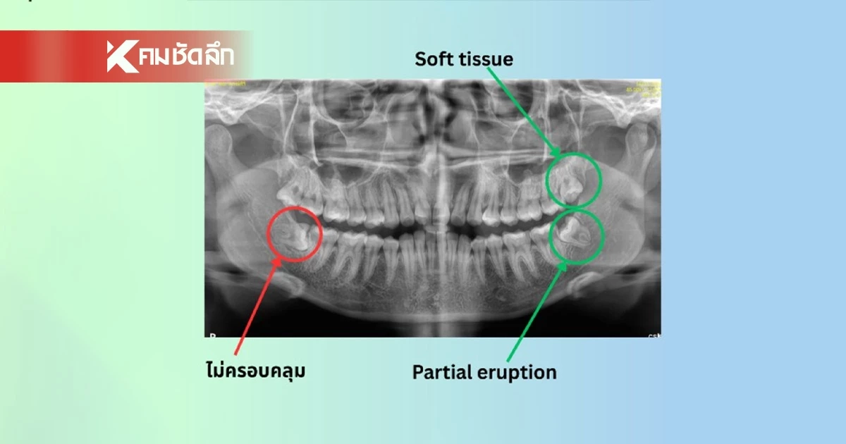ทันตแพทยสภา อธิบายสิทธิประโยชน์ "ผ่าฟันคุด" ในคลินิก สำหรับผู้ประกันตน