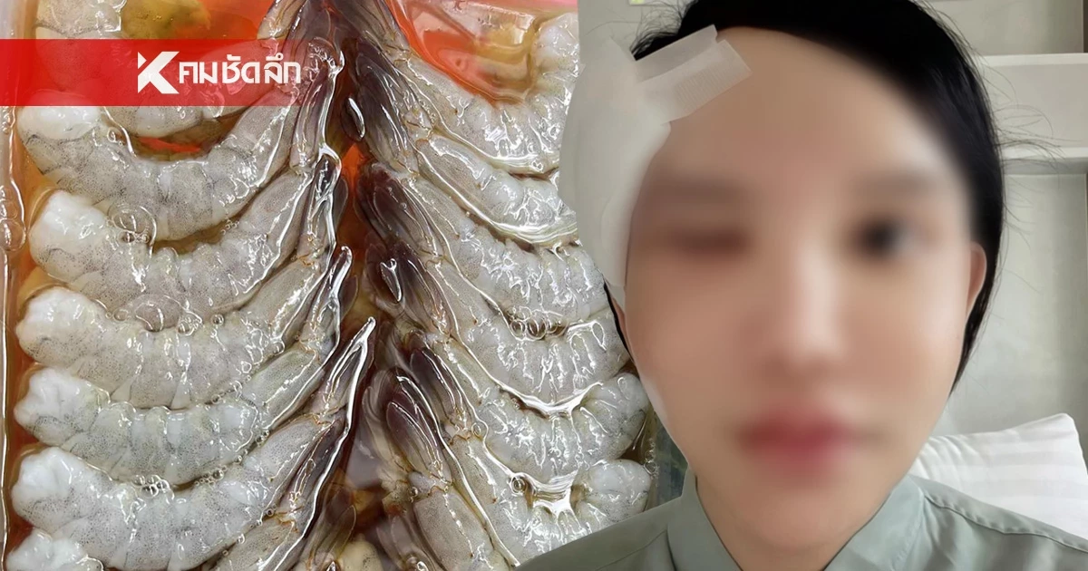 สาวโพสต์ติดเชื้อพยาธิลามไปที่ขอบตาหลังกิน "กุ้งแช่น้ำปลา"