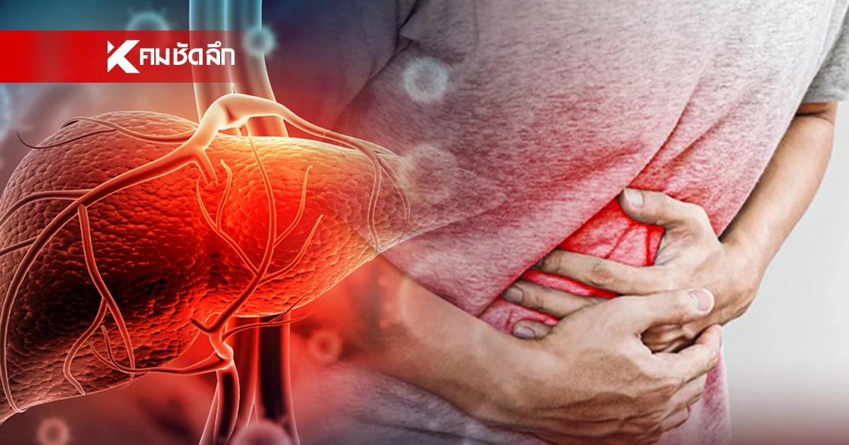 เช็ก 4 จังหวัด "ไวรัสตับอักเสบเอ" ระบาดพบผู้ป่วย 672 ราย