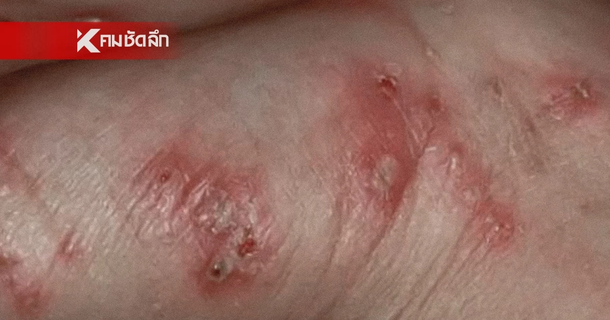 ​รัฐบาลเตือน พบผู้ป่วย "โรคไข้ดิน" พุ่ง 732 ราย เซ่นแล้ว 23 ชีวิต