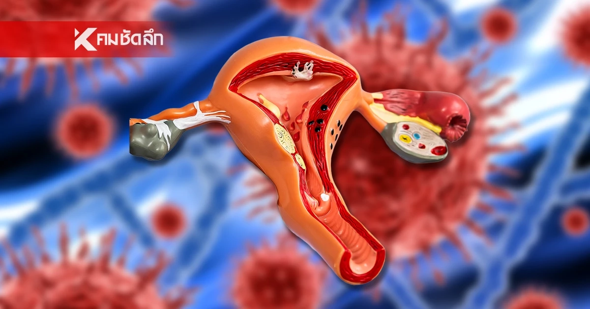 หายสงสัย! ดร.อนันต์ เฉลนั่งโถส้วมสาธารณะ ติด "HPV" ได้จริงหรือ?