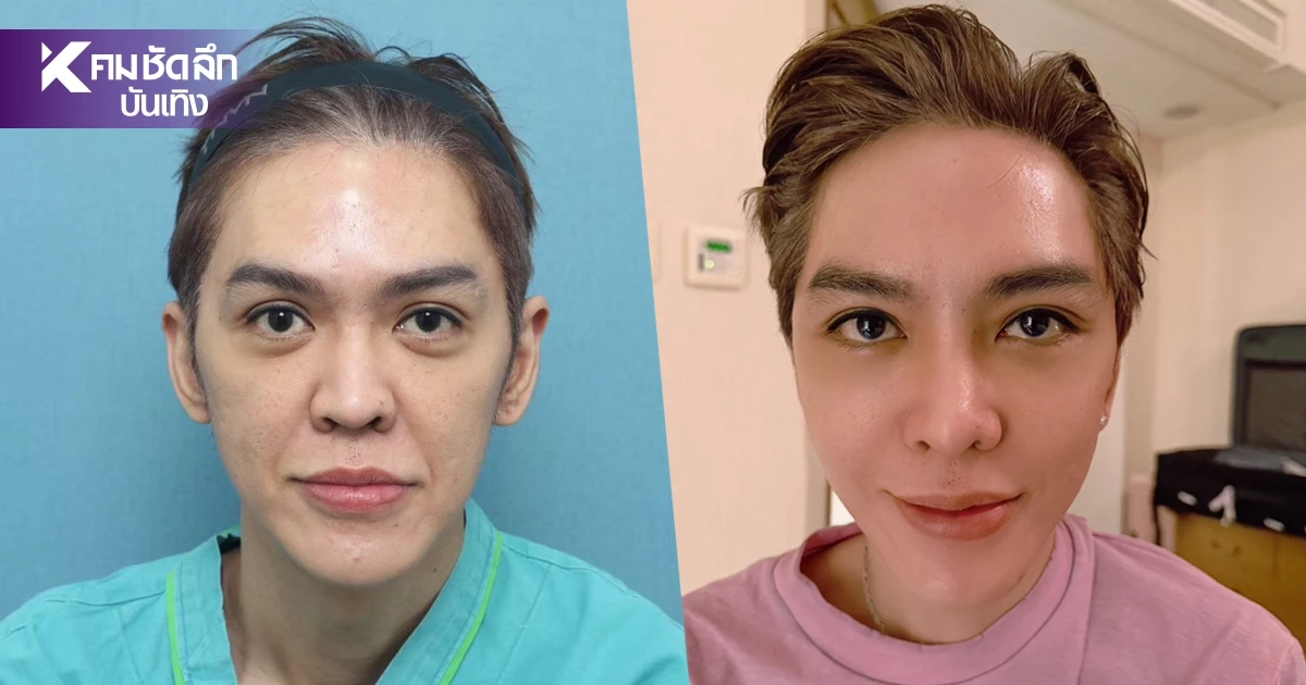 "ดัง พันกร" เผยหน้าเวอร์ชั่นล่าสุด เปิดใจหลังทำศัลยกรรมชุดใหญ่